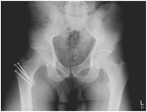 A postoperative radiograph of a surgical hip dislocation secured with ...