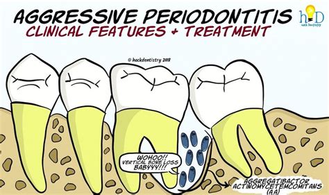 Periodontics Aggressive Periodontitis Clinical Features And Treatment