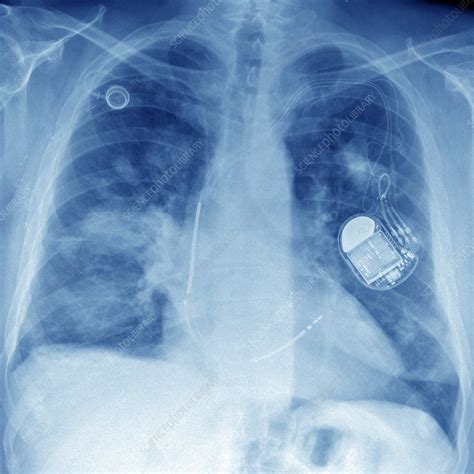 Secondary Lung Cancer X Ray Stock Image C047 3411 Science Photo