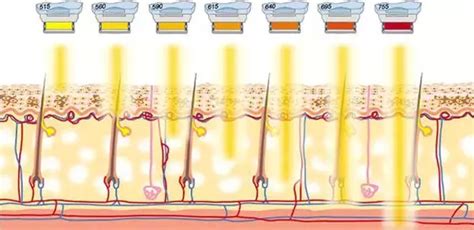 Luz Pulsada Intensa IPL Dra García Dihinx