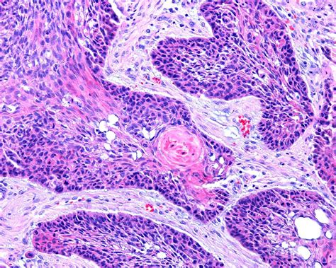 Squamous Cell Carcinoma Of The Larynx Photograph By Jose Calvo