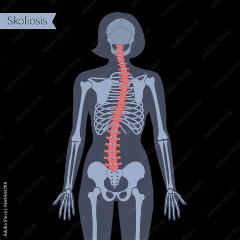 Spine X ray Stock Vector | Adobe Stock