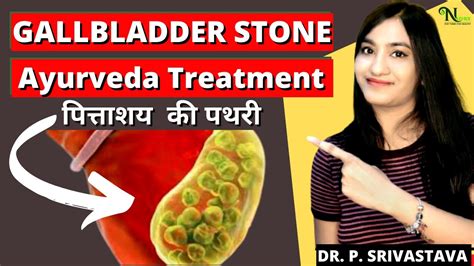 Ayurveda Treatment Of Gallbladder Stone Without Surgery Ayurvedic