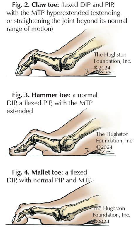 lesser toe deformities understanding claw toe hammer toe  mallet