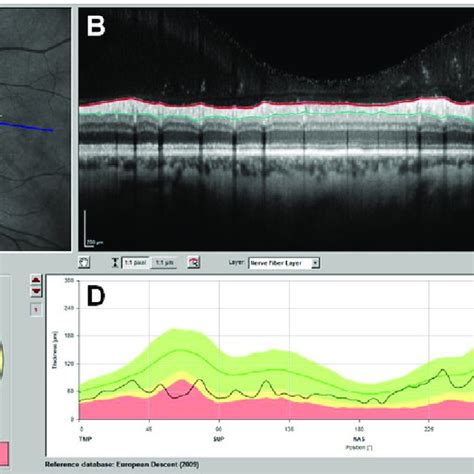 5 Peripapillary Oct Scan Captured Using Spectralis Oct Heidelberg