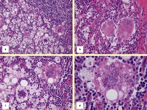 Multinucleated Giant Cells In Enlarged Axillary Lymph Nodes