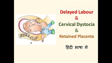 Delayed Labour Causes L Prolonged Labour L Cervical Dystocia L Retained Placenta L Gynaecology