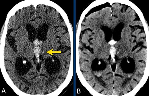 The Radiology Assistant Non Traumatic Intracranial Hemorrhage