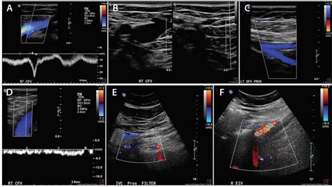 Diagnosis Of Iliac Vein Obstruction With Duplex Ultrasound