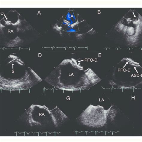 What Is A Pfo Procedure