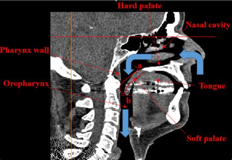 Soft Palate Pharynx