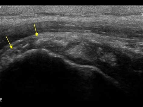 Musculoskeletal Joints and Tendons | 6.1 Shoulder : Case 6.1.18 Bursa ...