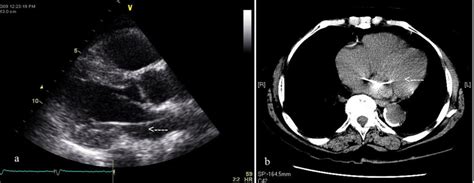 A Echocardiogram Showing The Presence Of The Ventricular Pacing Lead