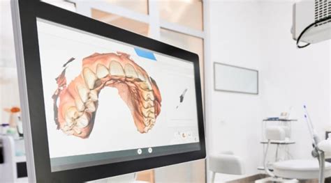 Ventajas Del Esc Ner Intraoral D Precisi N Comodidad Y Rapidez