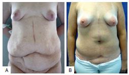 RBCP Cirurgia plástica pós bariátrica experiêcia no Conjunto