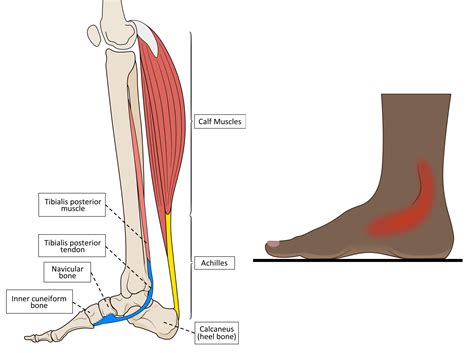 Tibialis Posterior Dysfunction (TPD) is a Pain in the ‘Ankle’ and ‘Arch
