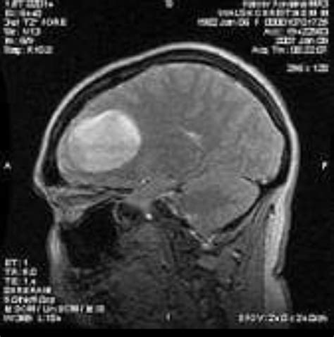 Glioma Grau 4 Depoimentos - Glioblastoma Multiforme Grau 4 Fase Terminal - RETOEDU