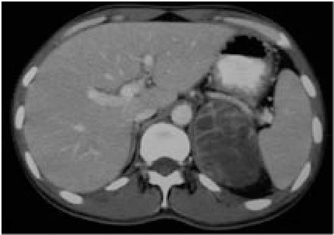 Contrast Enhanced Axial Ct Image Of The Abdomen Download Scientific