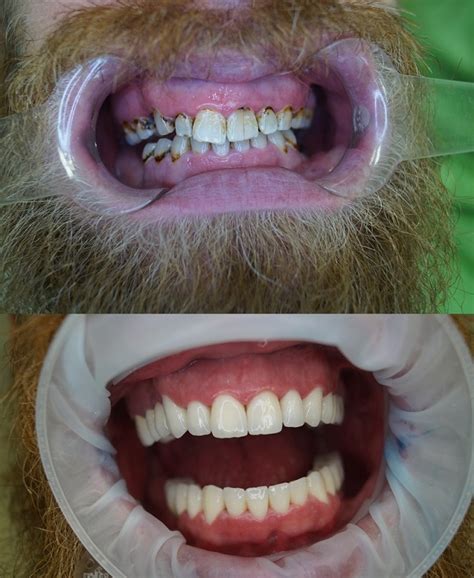 Dental Crowns Before And After