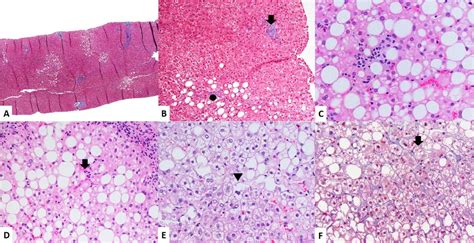 Fatty Liver Histology