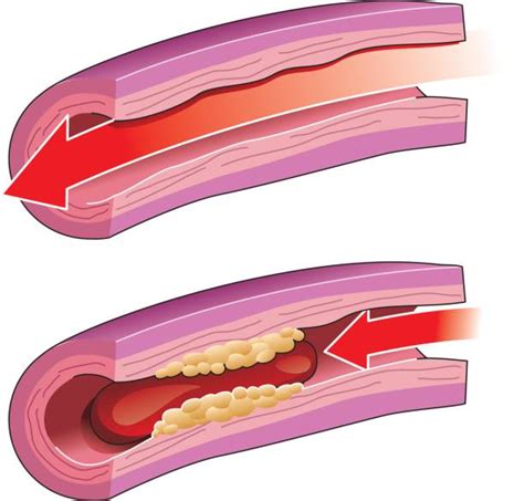 Clogged Arteries Clip Art