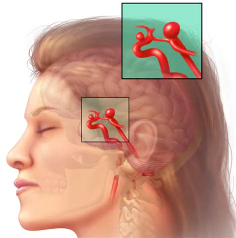 C V Rd Vid Stroke Och Sjukdomar I Centrala Nervsystemet Flashcards