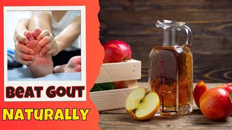 Beat Gout Naturally Simple Home Remedies Youtube