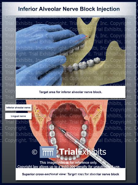 Inferior Alveolar Nerve Block Injection Trialquest Inc