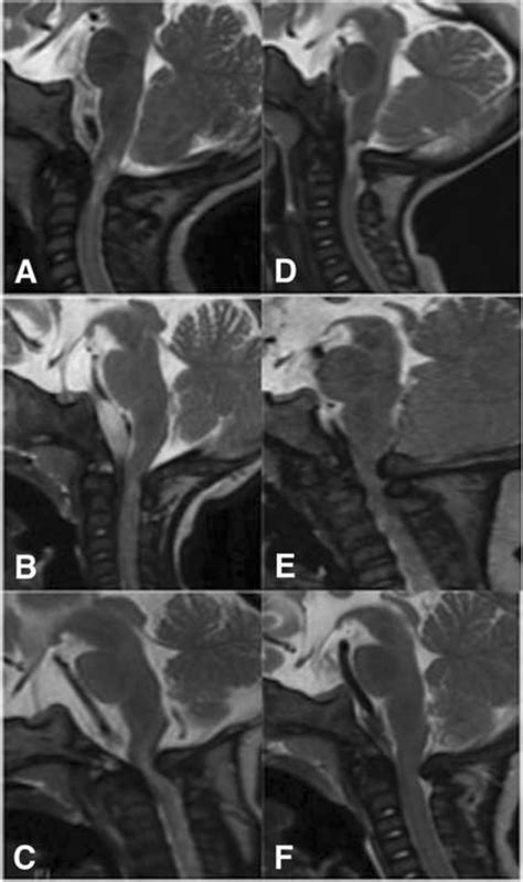 Midsagittal T2 Preoperative Images Of The Cervico Medullary Region