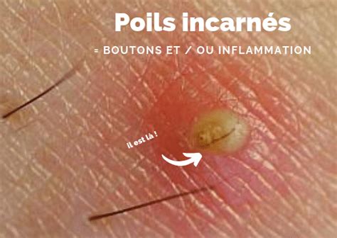 Poils incarnés que faire lessentieldejulien