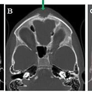 Axial computed tomography (CT) soft tissue window shows a lytic ...