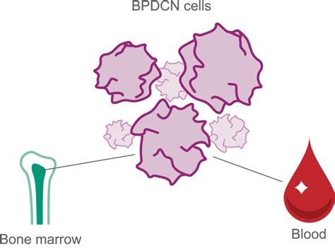 What Is BPDCN? | ELZONRIS® (tagraxofusp-erzs)