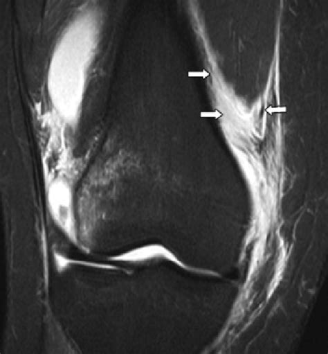 Vastus Medialis Oblique Mri