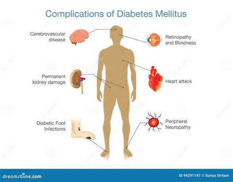 Complica Es Do Diabetes Mellitus Ilustra O Do Vetor Ilustra O De