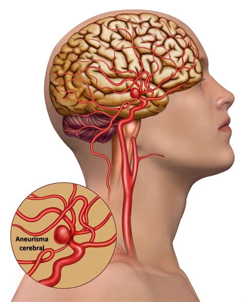 Aneurismas Cerebrais Dra Raquel Rodrigues Neurocirurgia Pediátrica