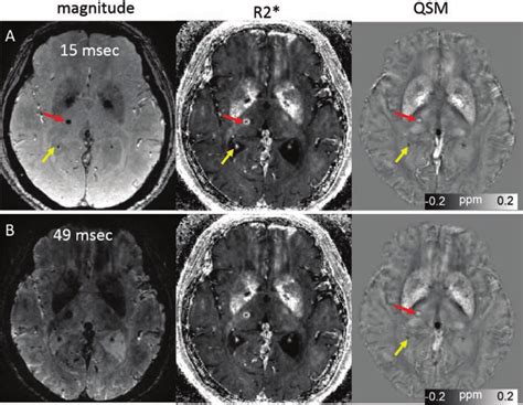 Quantitative Susceptibility Mapping For Measuring Paramagnetic