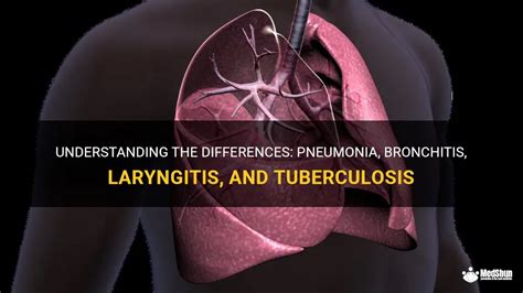 Understanding The Differences Pneumonia Bronchitis Laryngitis And