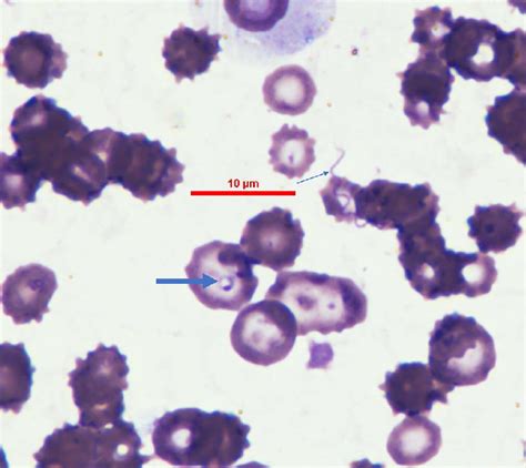 Blood smear from case number 3 on its first admission before treatment ...