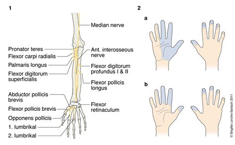 N Medianus Patienth Ndbogen P Sundhed Dk