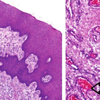 Photomicrograph Ofpyogenic Granuloma With Hyperplastic Epithelium That