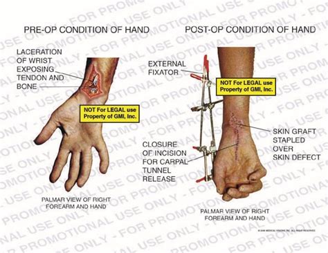 Pre Op Vs Post Op Conditions Of Hand 95204c Generic Medical Legal Exhibits A Division Of Mvi