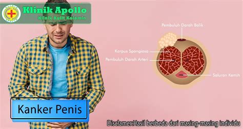 Kanker Penis Penyebab Ciri Ciri Dan Pengobatan Klinik Apollo Jakarta