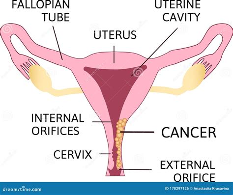 Cervical Cancer Carcinoma Of Cervix Stock Illustration Illustration Of Medicine Female