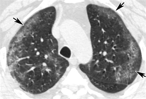 Multisystem Imaging Manifestations Of Covid Part Viral