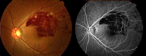 Retinal Vein Occlusion | Brisbane Ophthalmologist & Retina Treatment