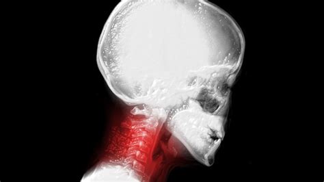 Understanding Cervical Radiculopathy Causes Symptoms And Treatments