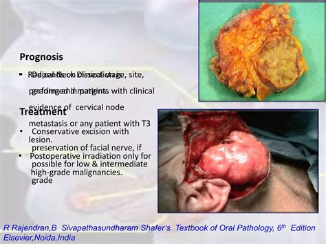 Tumors Of Salivary Glands Ppt Free Download