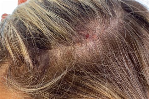 Psoriasis Of The Scalp Psoriatic Redness Peeling And Crusts On The