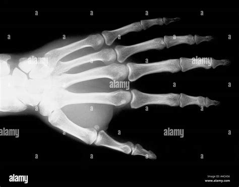 X Ray Image Of Hand Stock Photo Alamy