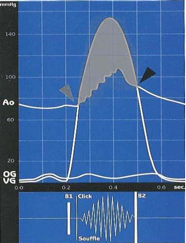 S10C4 Valvulopathies Auscultation Cardiaque Cartes Quizlet